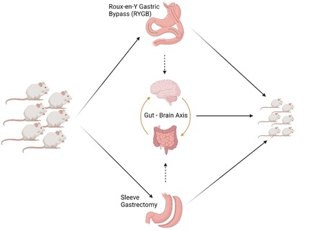 graphic showing Roux-en-Y Gastric Bypass and Sleeve Gastrectomy